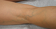 los angeles, spider veins